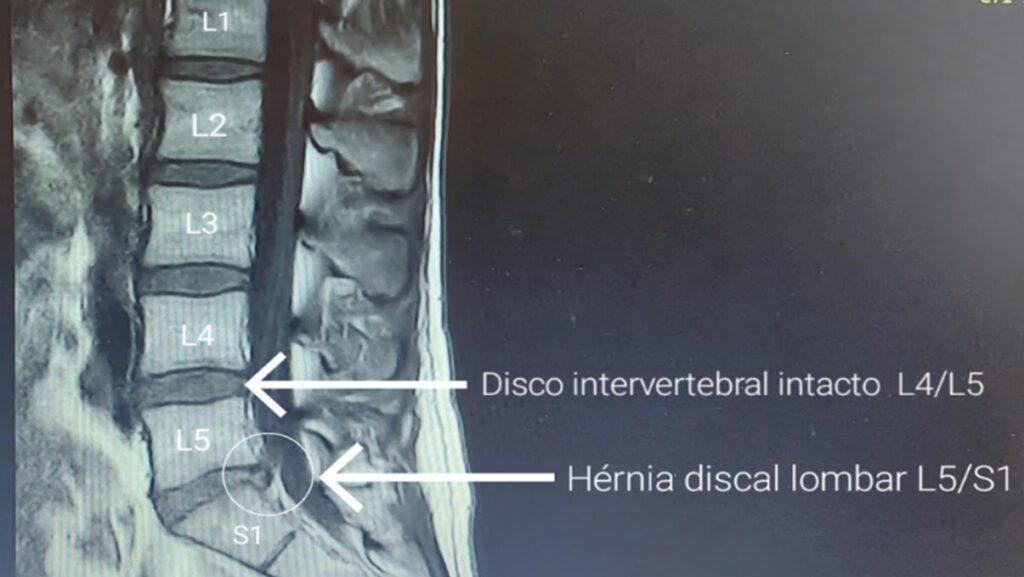 Hérnia discal lombar com radiculopatia e exercício físico